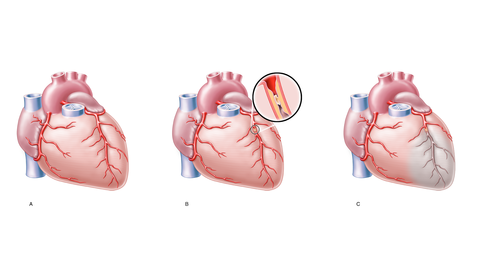 Verlauf eines Herzinfarks