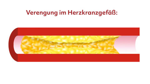 Verengung im Herzkranzgefäß.