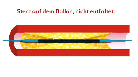 Stent auf dem Ballon, nicht entfaltet