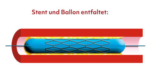 Stent und Ballon entfaltet.