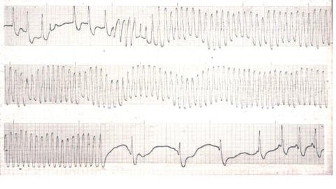 Darstellung einer Kammertachykardie