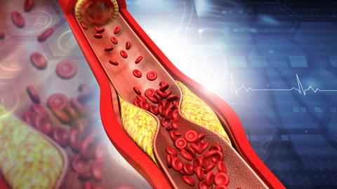 Bild von einer Blutbahn, die durch Plaques verengt ist