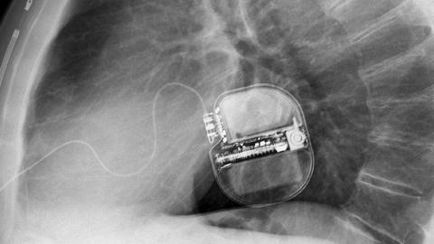 Röntgenbild von einem Defi
