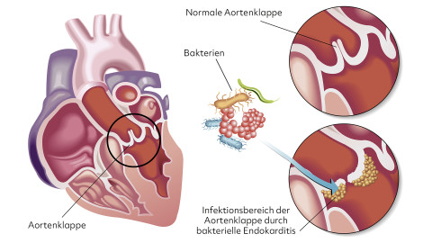 Schaubild Bakterien an der Aortenklappe 