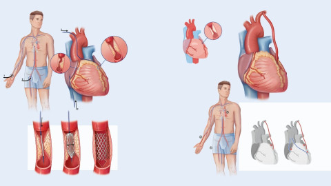 Darstellung Bypass und PCI